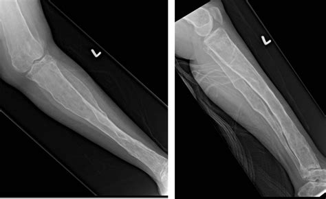 parra prada arezzo|Polyostotic form of fibrous dysplasia in a 13 years old Colombian .